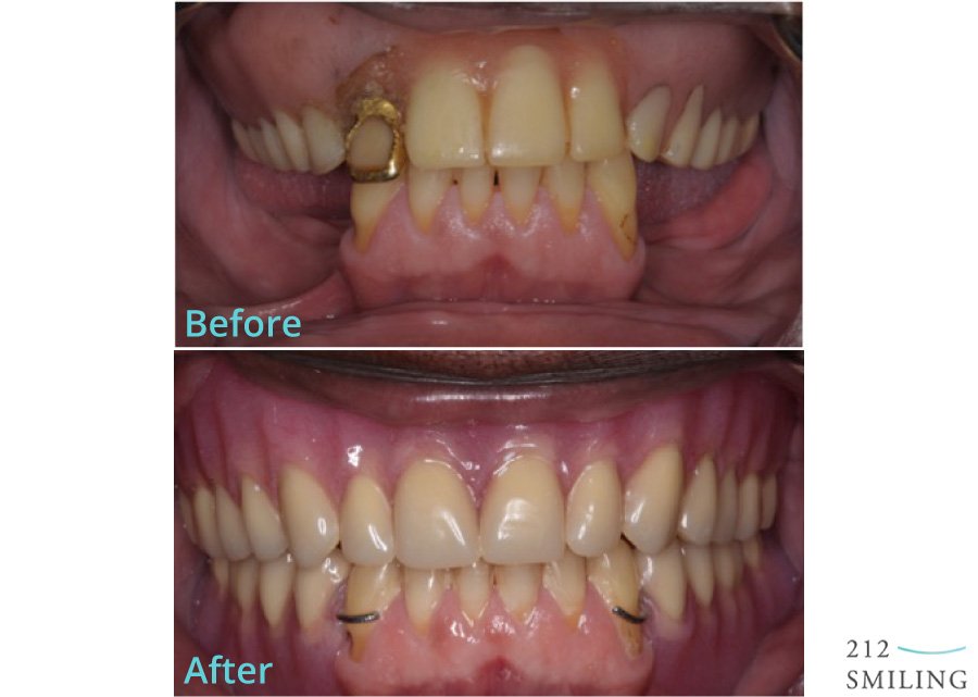 Enhance Your Smile: Before And After Partial Dentures